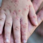 Mantienen bajo vigilancia brotes de coxsackie en escuelas de Querétaro